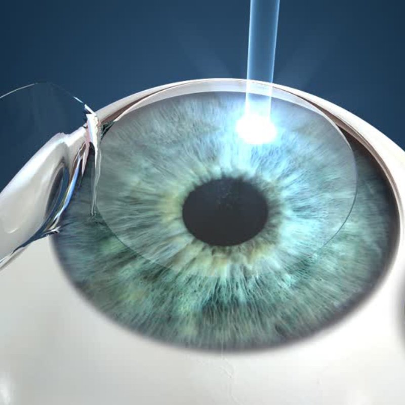 Ojo de paciente con marcas de preparación para cirugía refractiva o de cataratas